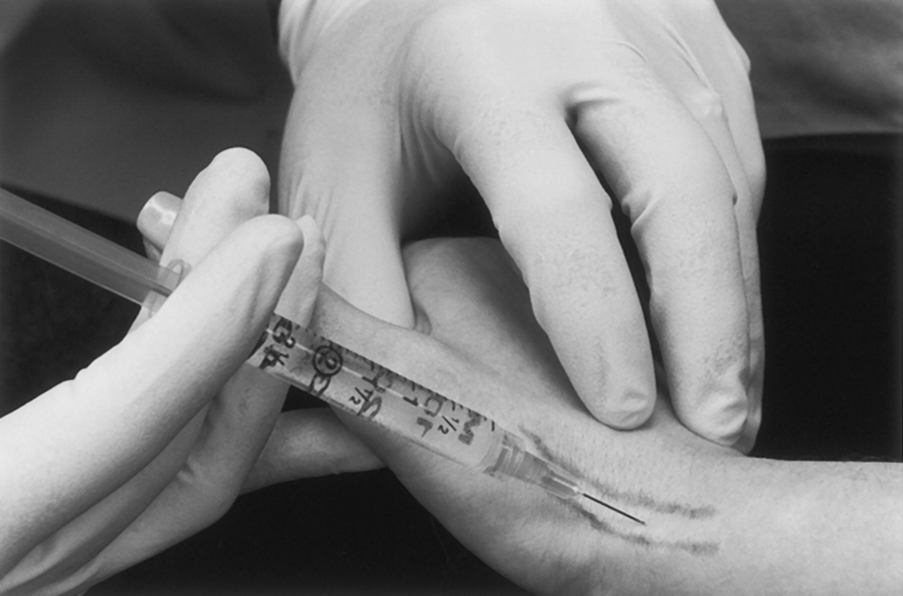 Corticosteroid injection Corticosteroid injection